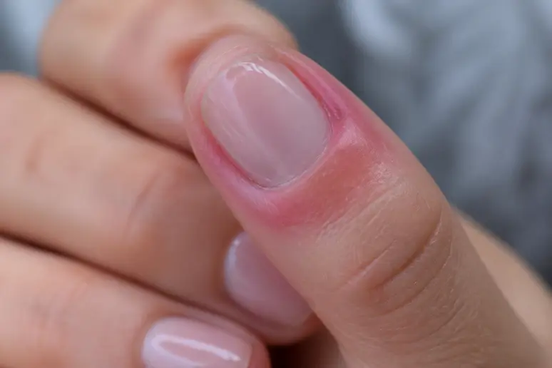 Manucure hiver : rougeurs et gonflement cuticulaire post-application de vernis semi-permanent.