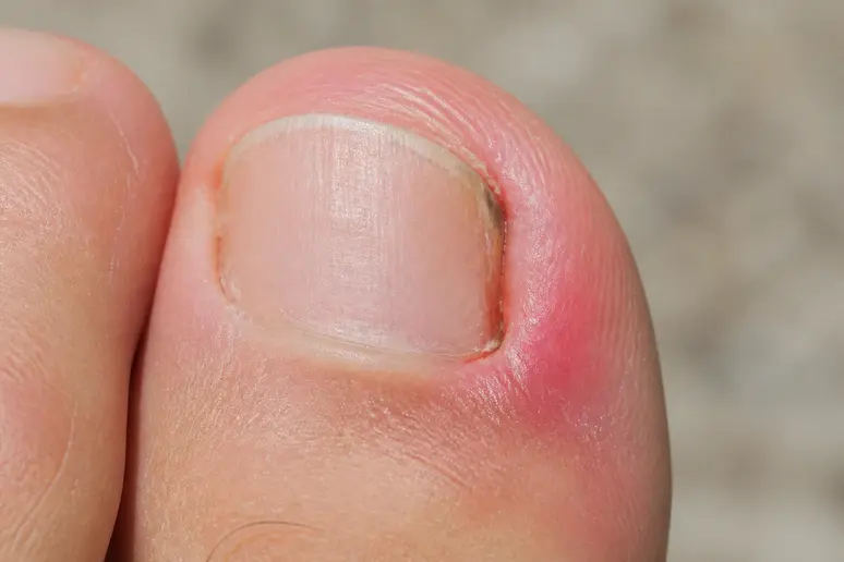 Signes d'inflammation légère sur le bord d'un ongle de pied, signal pour la manucure pieds femme.