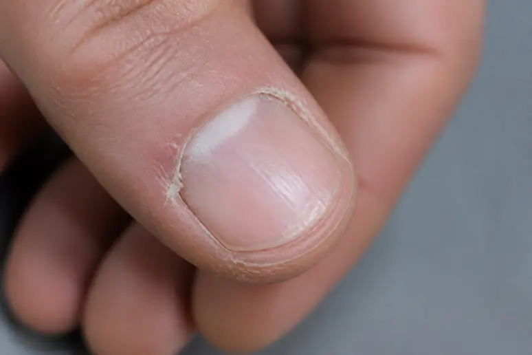 Exemple de cuticules négligées, une erreur à éviter pour un nail art Octobre Rose.