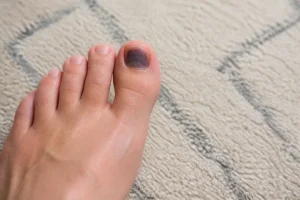 Gros plan d'un ongle de pied noir sans choc, suggérant une préoccupation pour la santé cutanée.