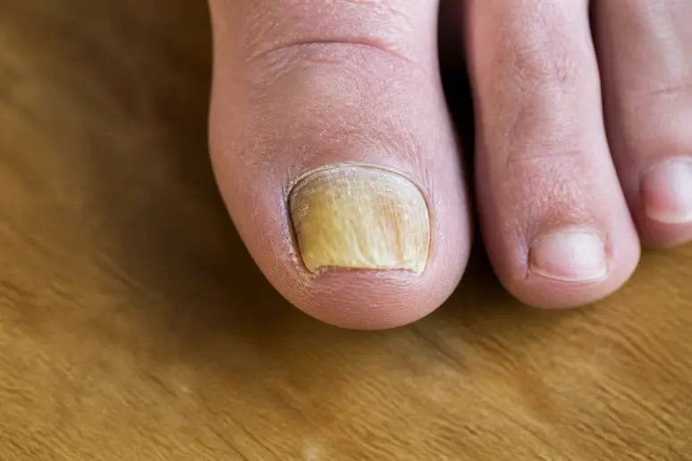 Aspect d'un ongle de pied qui se décolle, jaunâtre et épaissi par une mycose.