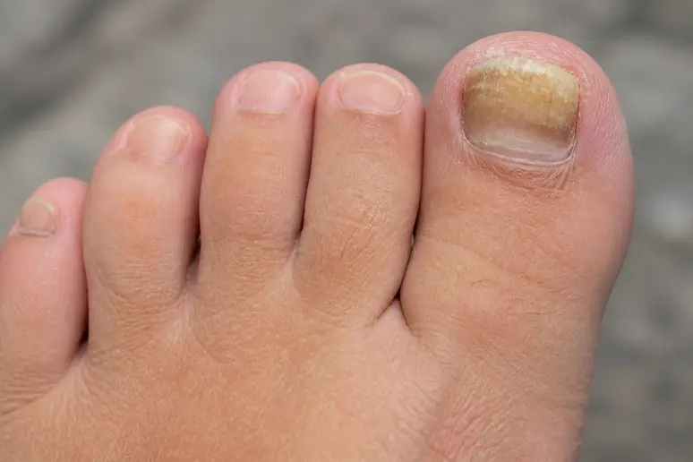 Signes d'infection sur les ongles de pieds : épaississement et décoloration des ongles de pieds.