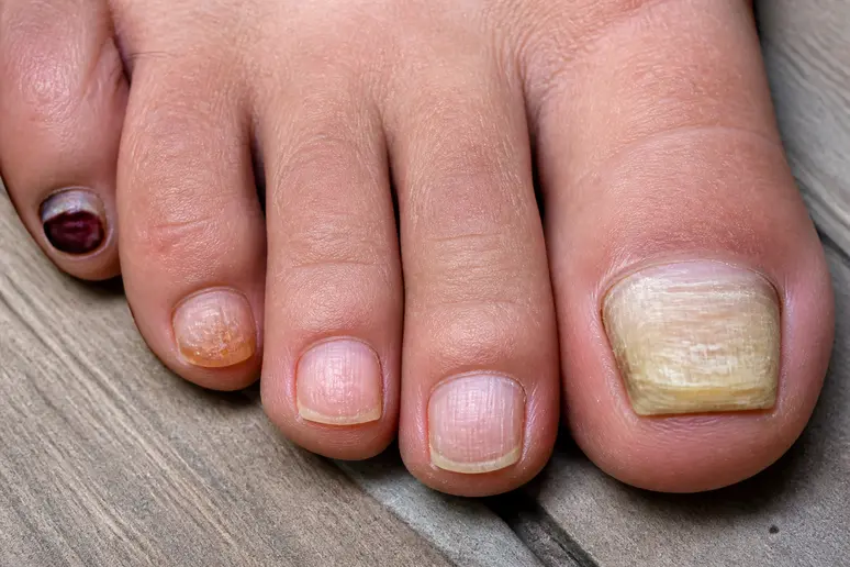 Visualisation des ongles de pieds jaunes et épais, comparés à des ongles abîmés par un traumatisme ou affectés par le psoriasis.