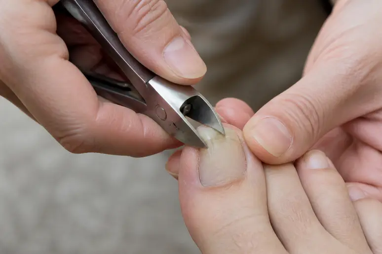 Utilisation d'une pince sécateur pour couper un ongle de pied épaissi, geste préventif pour les ongles de pieds jaunes et épais.