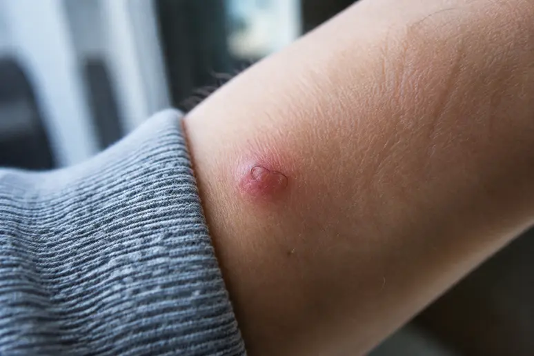 Gros plan sur une petite bosse rouge révélant un bouton poil incarné sous l'épiderme